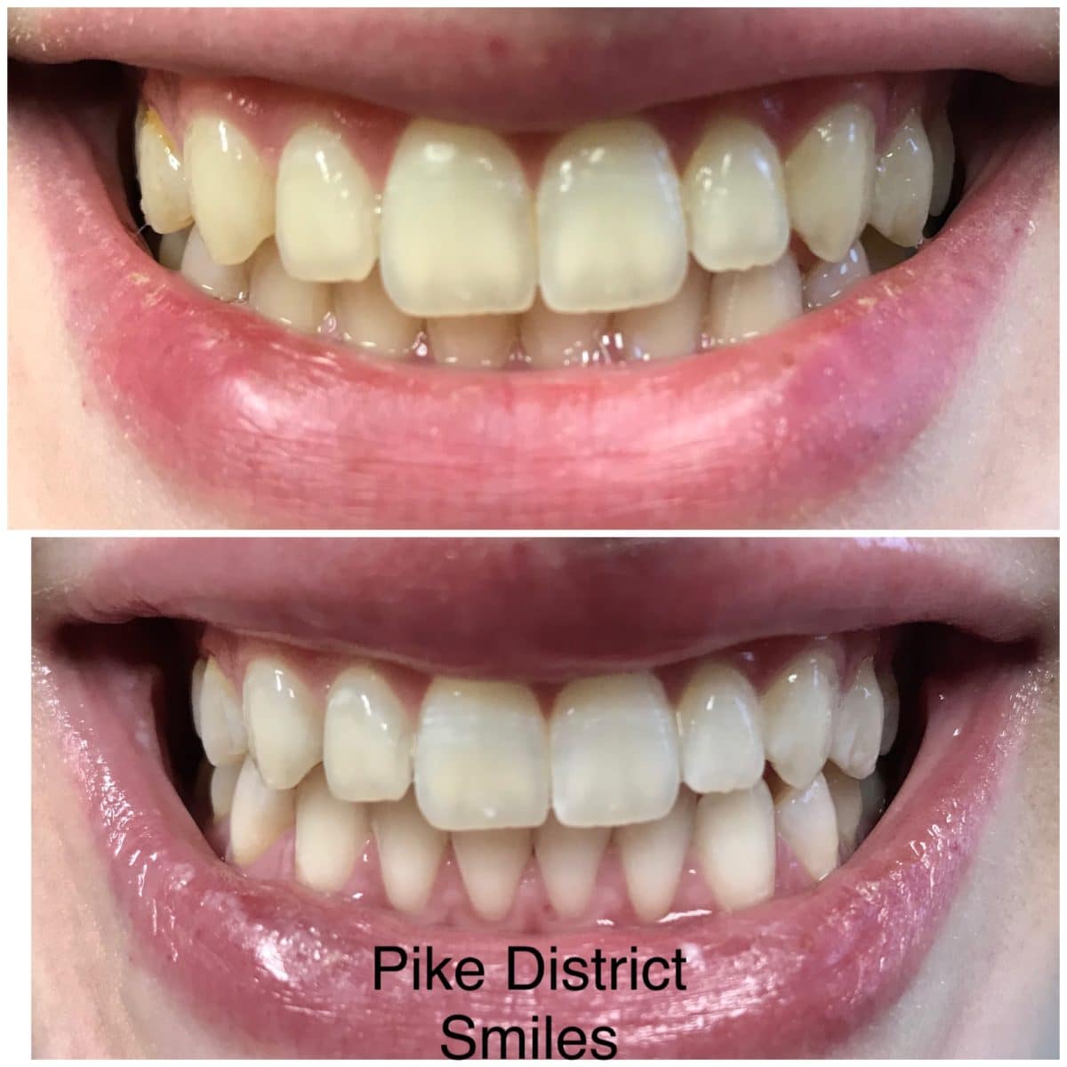 Up and down comparison of teeth whitening results at Pike District Smiles.