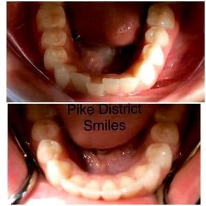 Up and down comparison of dental Invisalign aligners before and after treatment at Pike District Smiles.