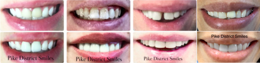 Series of jaw photos showcasing the positive change from using dental veneers from Pike District Smiles.