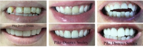 Before and after dental crown treatment comparison shown on a photo of teeth.