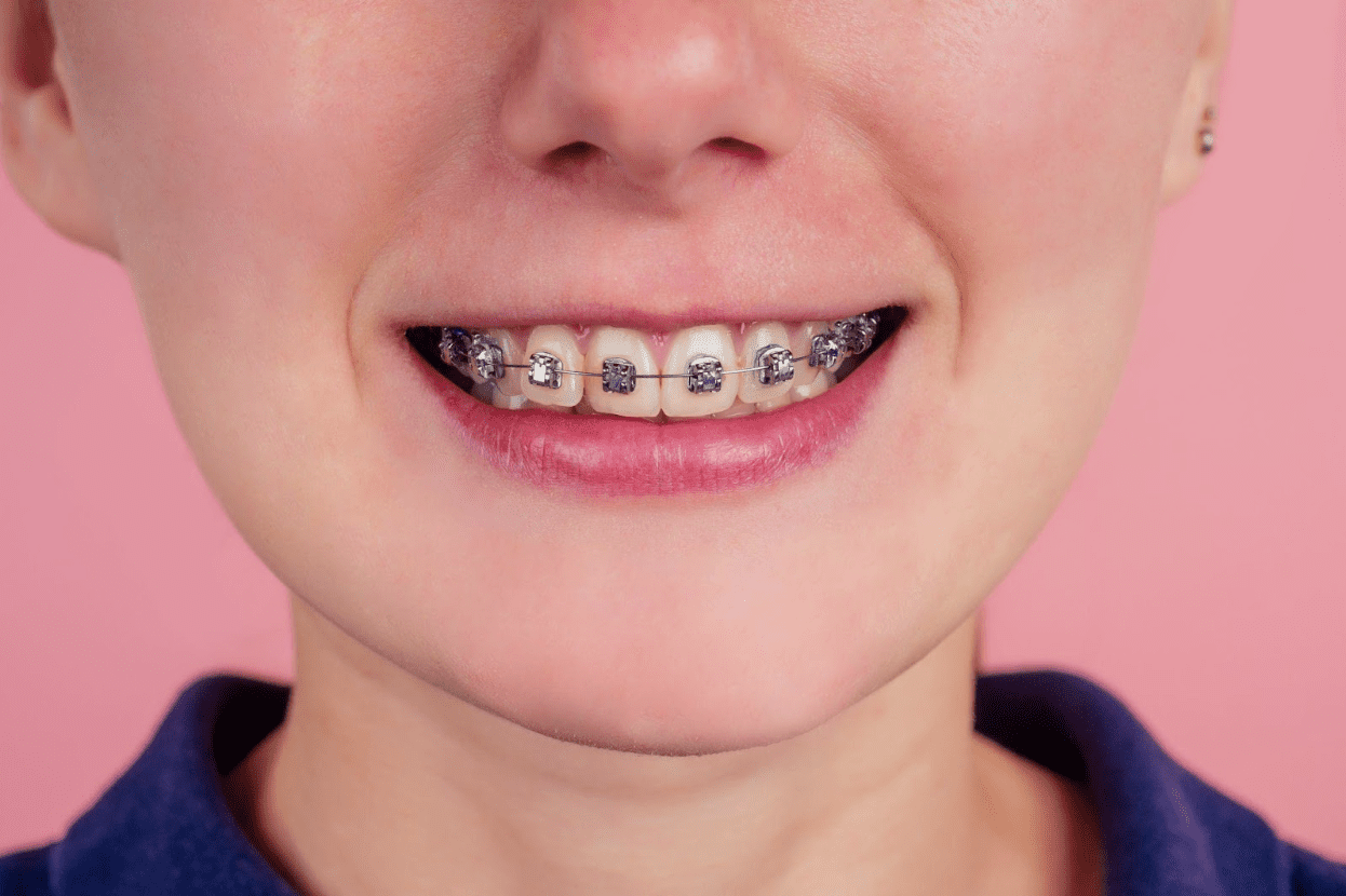 Teenager proudly displaying her braces.