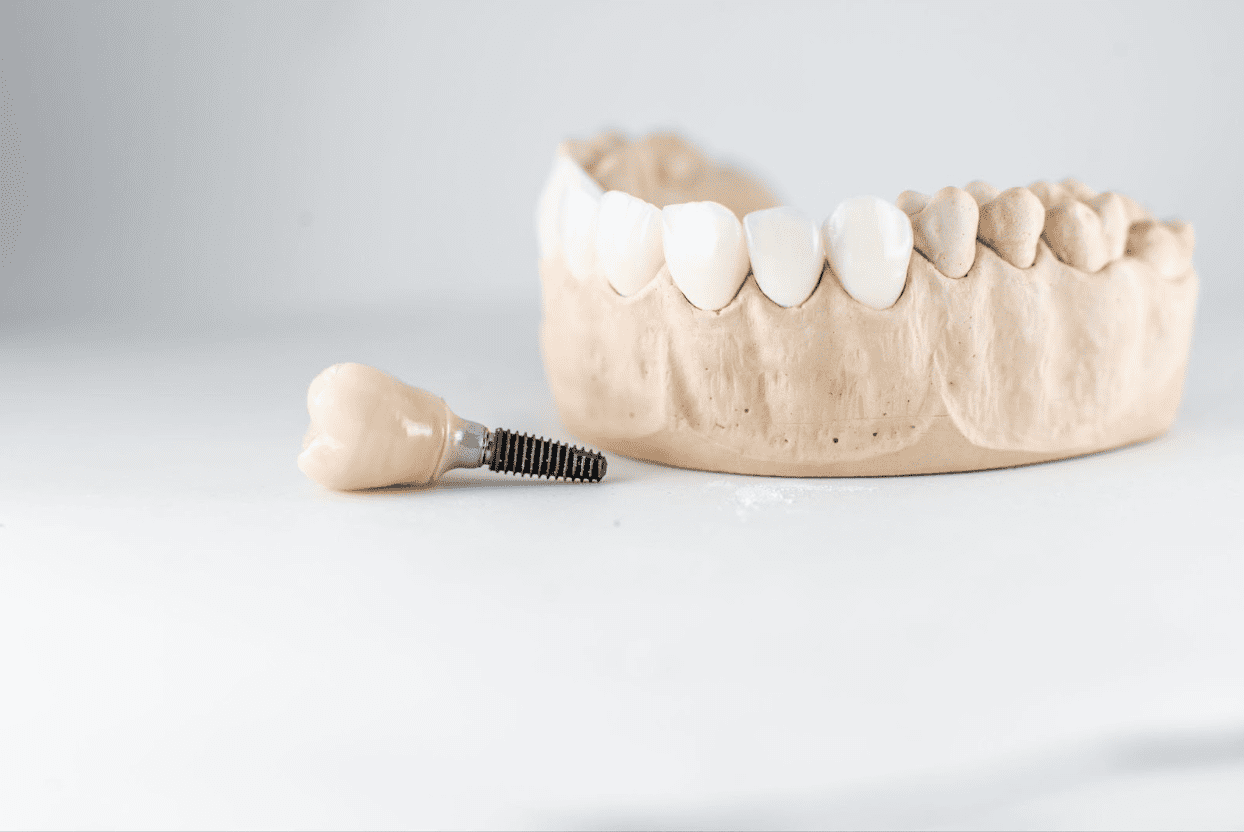 Dental teeth dummy placed on the table, one tooth is detached with an implant attached to it, highlighting dental implant importance.