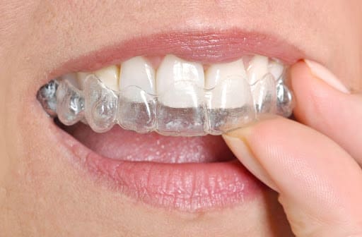 Patient placing Invisalign aligner on her teeth.