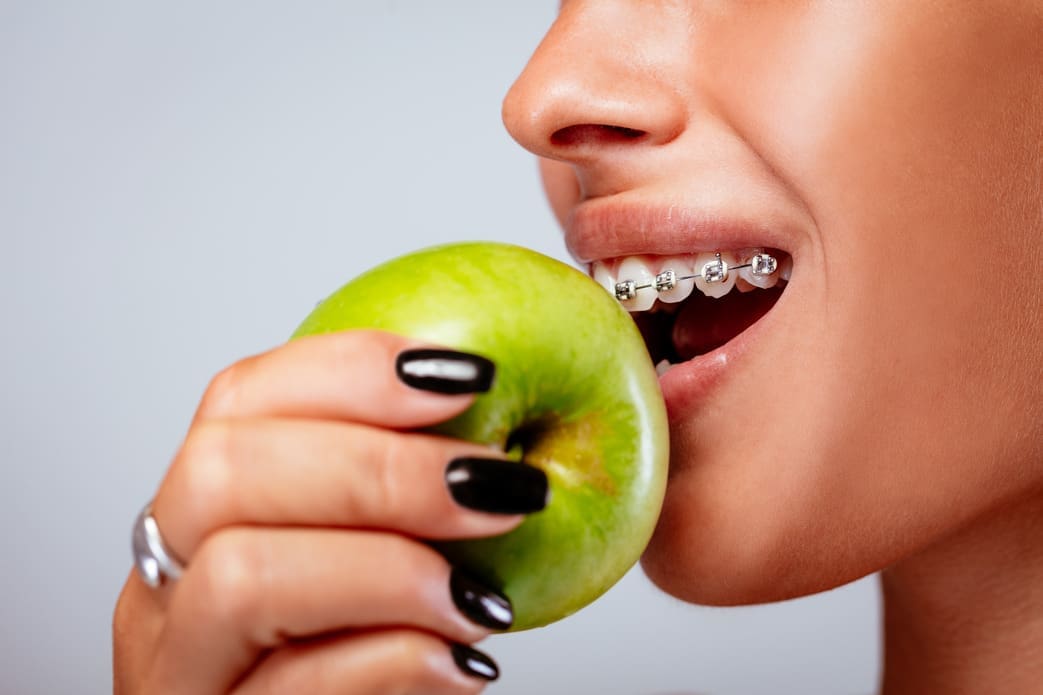 Happy patient cheerfully biting into an apple while wearing braces on her teeth.