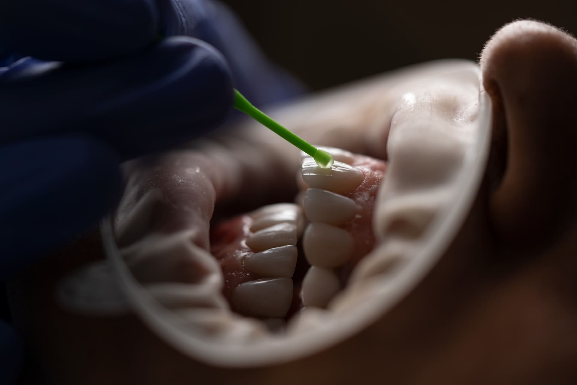 Dentist gently cleaning patient's teeth with the assistance of a mouth opening instrument.