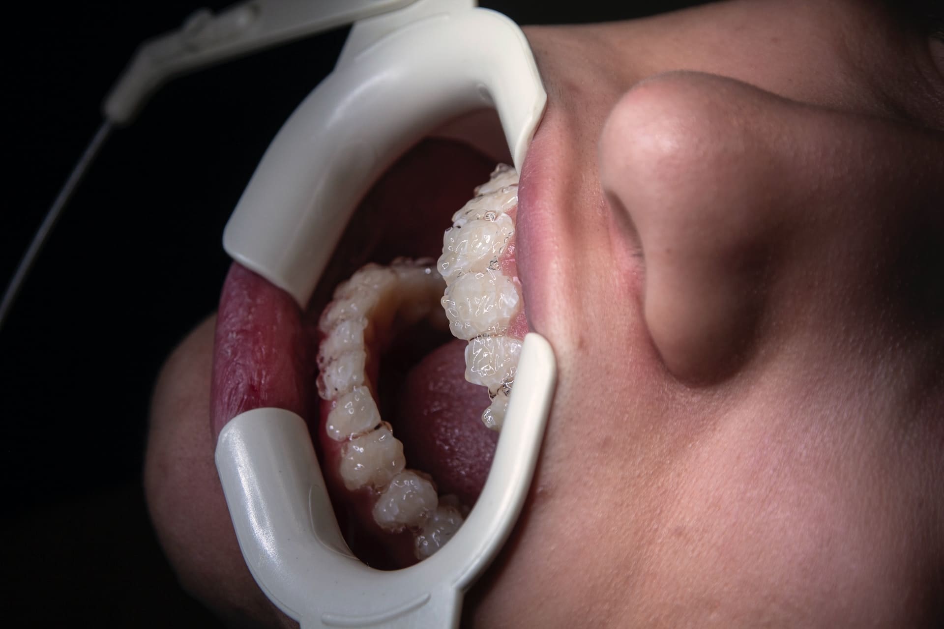Mouth opener device placed in the patient's mouth, revealing the teeth.