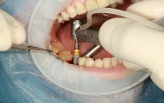 Dental implant procedure taking place at Pike District Smiles. Dental Bridges vs Implants