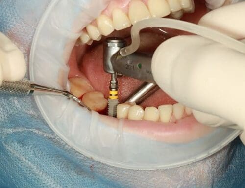 Dental Bridges vs Implant: Which is Right for You?
